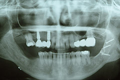 Radiographie après