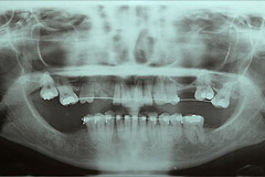 Radiographie avant