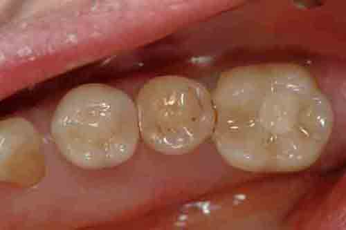 Photo de prosthodontie