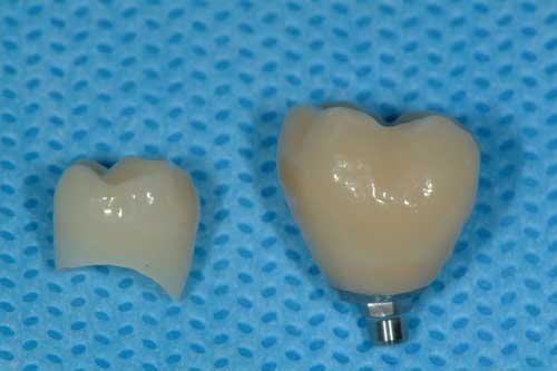 Photo de prosthodontie